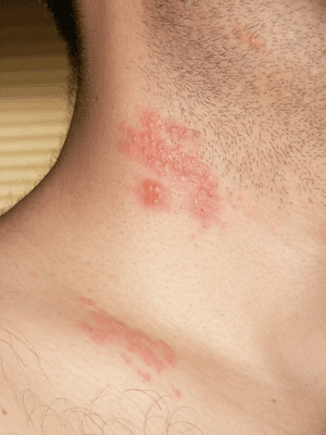 Herpes Zoster (Shingles) Treatment - SKINFUDGE® - Center of Skin & Hair Excellence