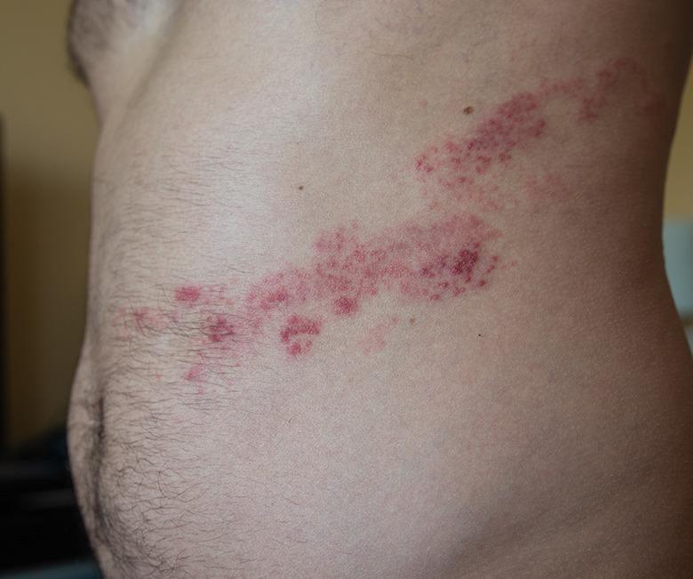 Herpes Zoster (Shingles) Treatment - SKINFUDGE® - Center of Skin & Hair Excellence