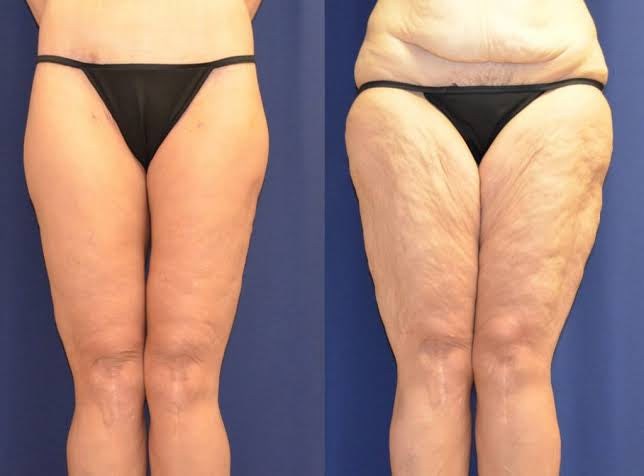 Liposuction Vs Cryolipolysis Differences And Side Effects