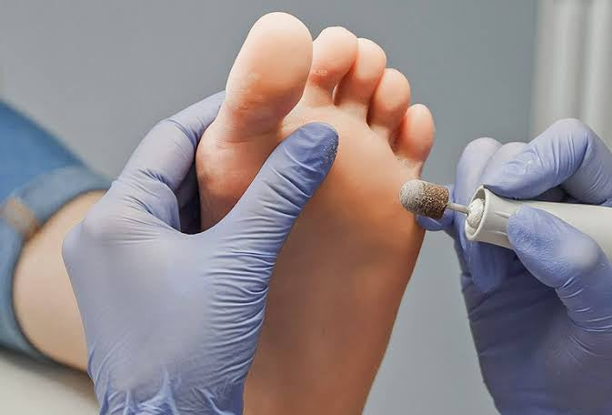 A Comprehensive Guide to Wart Removal: Genital Warts, Plantar Foot Warts, and Body Warts