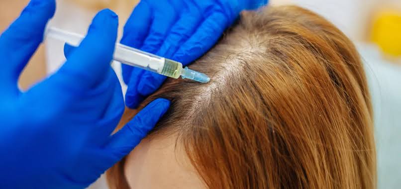 Can PRP / PRF Grow Hair on Bald Scalp?