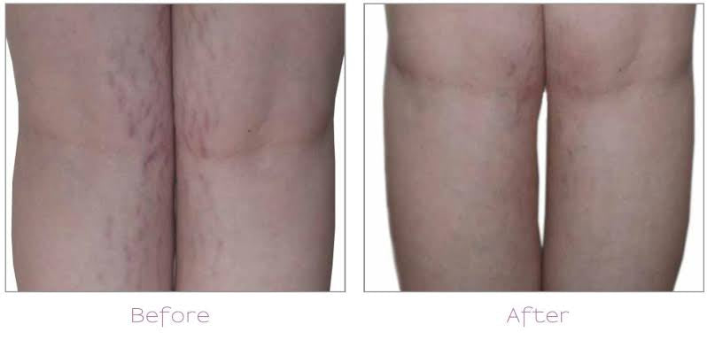 Can Laser Hair Removal Tighten the Skin?