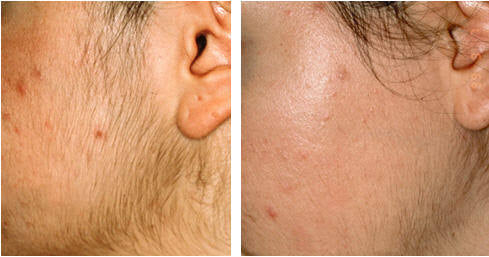 What is Success Rate of Laser Hair Removal on Face?