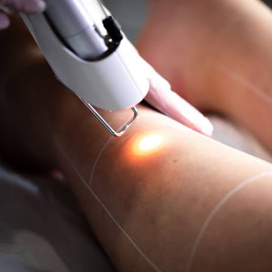 Why Is Laser Hair Removal Treatment Good for Skin?