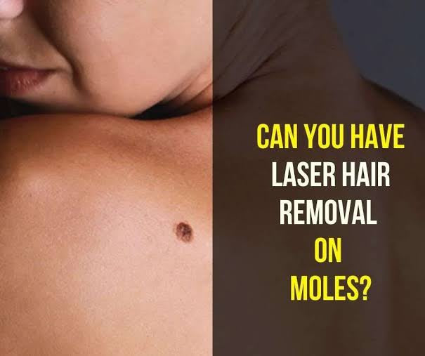 Will Laser Hair Removal Hurt the Skin Around a Mole?