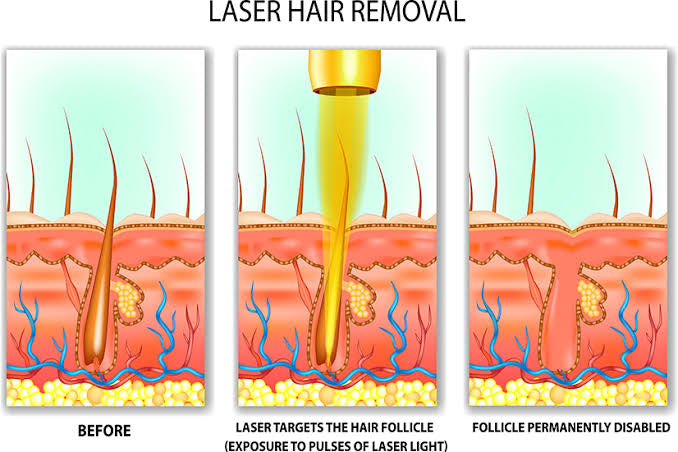 How many laser treatments are there to remove hair?