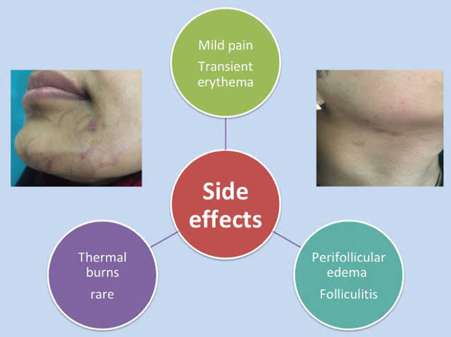 What Are The Side Efects of Laser Hair Removal?