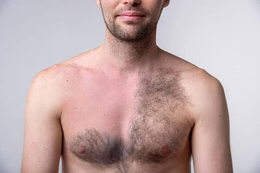 Does laser hair removal work on men? Is it permanent?