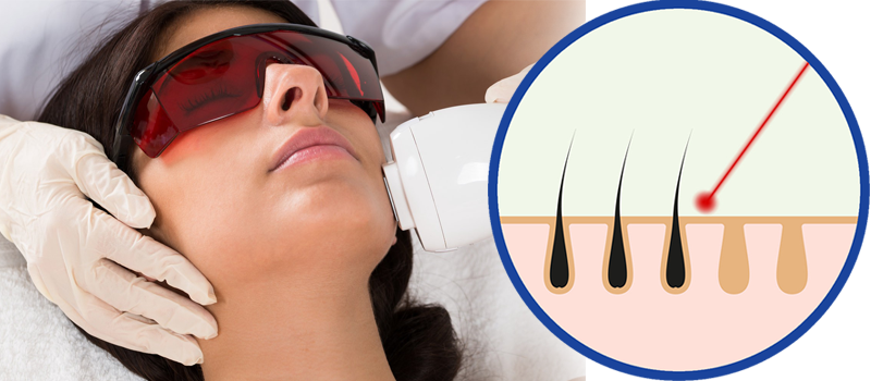 Is laser hair removal really removal or is it just reduction?
