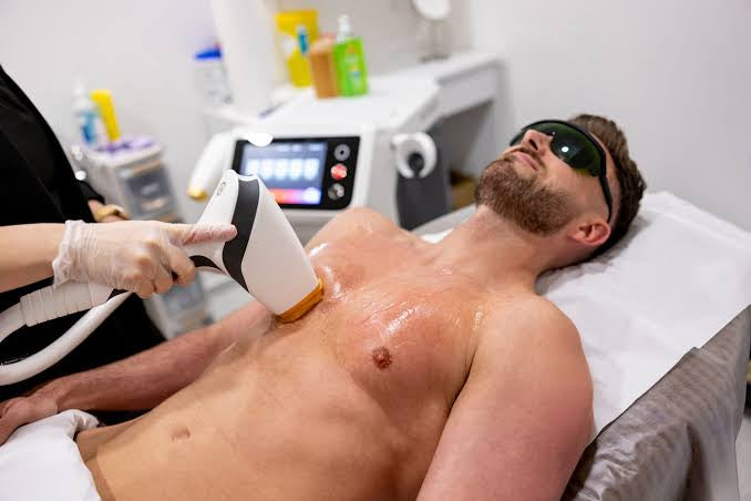 What is laser hair removal for men, and how does it work?