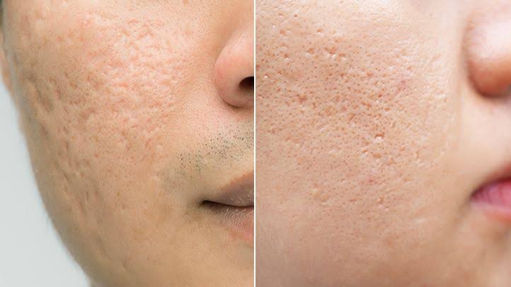What is the best treatment for acne scars?