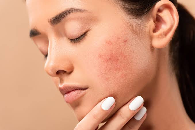 What is the best acne scar treatment for brown Asian skin?