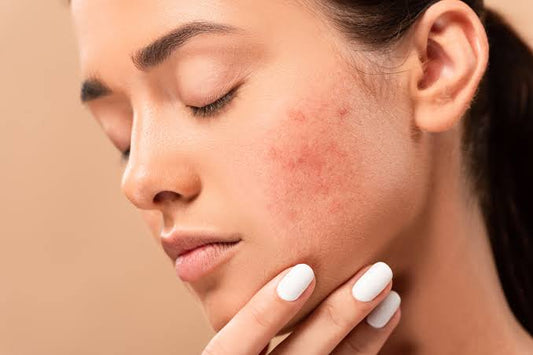 What is the best treatment for acne scar on a full face?