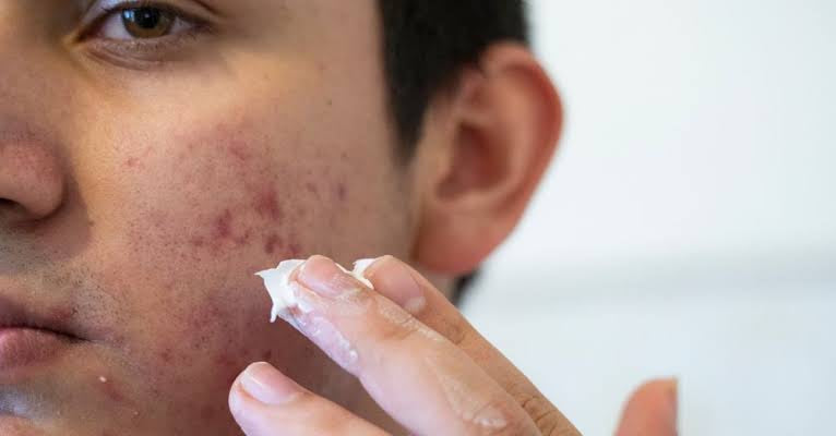 How to remove acne scars?