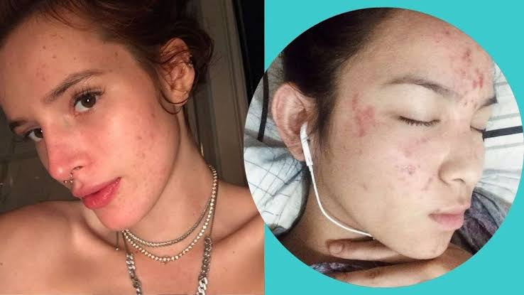 How do celebrities get rid of acne scars?