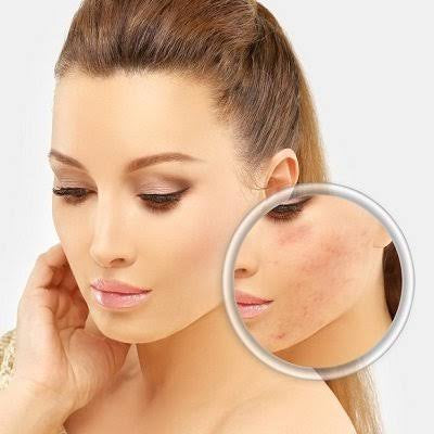 What kind of treatment works for acne scars?