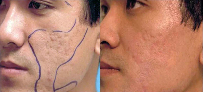 Is it safe to use laser treatment for acne scars?