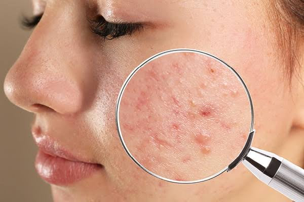 What is the best treatment for pitted acne scars?