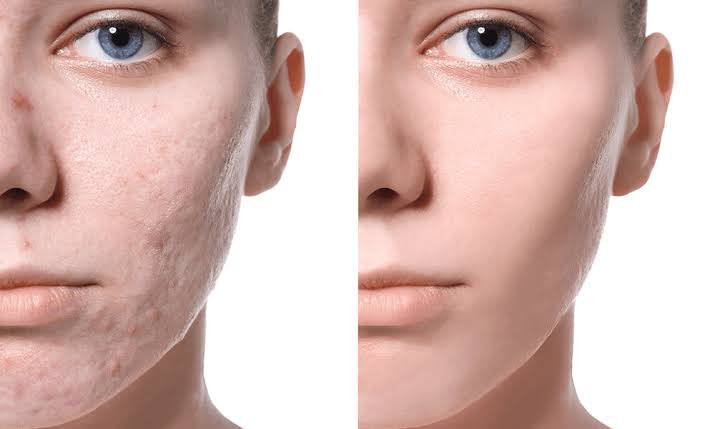 How does acne scar treatment work?