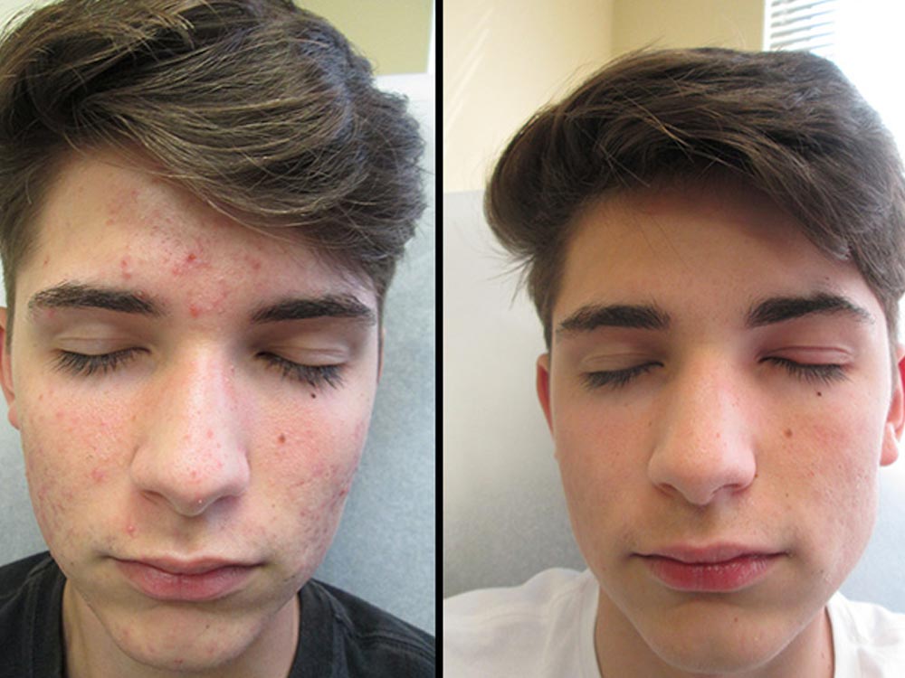 Acne Scars: Treatment Options