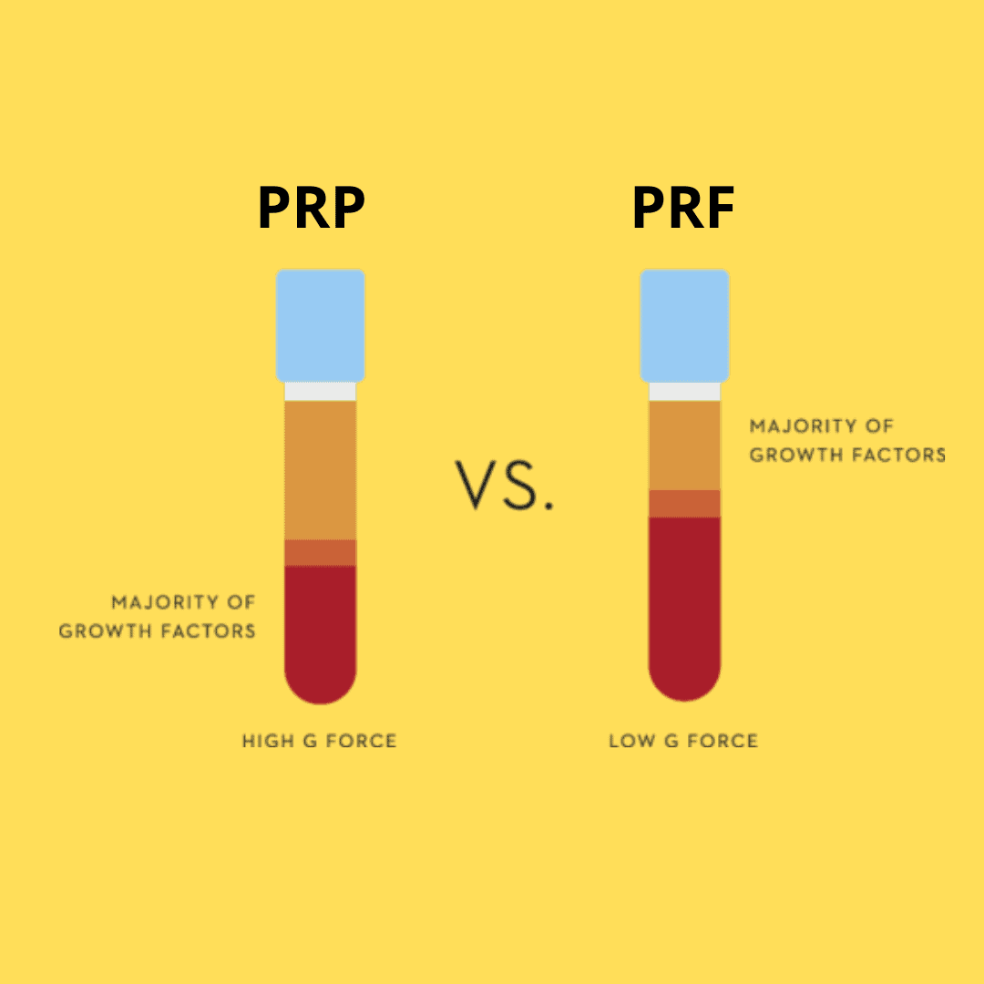 Difference Between PRP, PRF and PRGF - SKINFUDGE® Clinics (Dermatology, Plastic Surgery & Laser Center)
