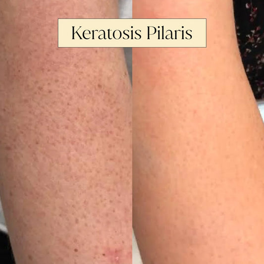 Keratosis Pilaris Treatment SKINFUDGE® Clinics (Dermatology, Plastic Surgery & Laser Center)