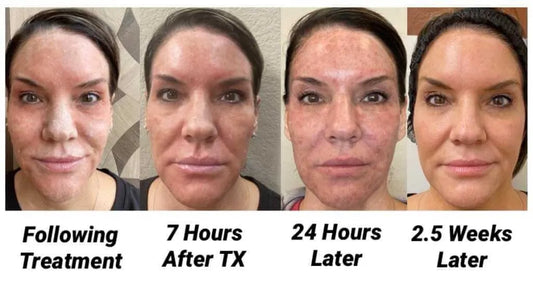 Erbium Yag Laser Resurfacing | Acne Scars, Face Scars, Uneven skin tone SKINFUDGE