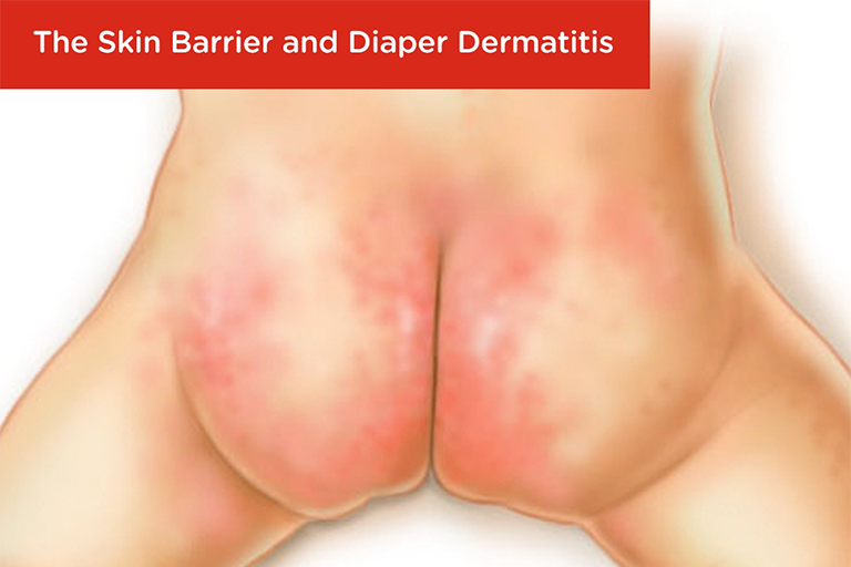 Diaper Dermatitis (Diaper Rash) SKINFUDGE® Clinics (Dermatology, Plastic Surgery & Laser Center)