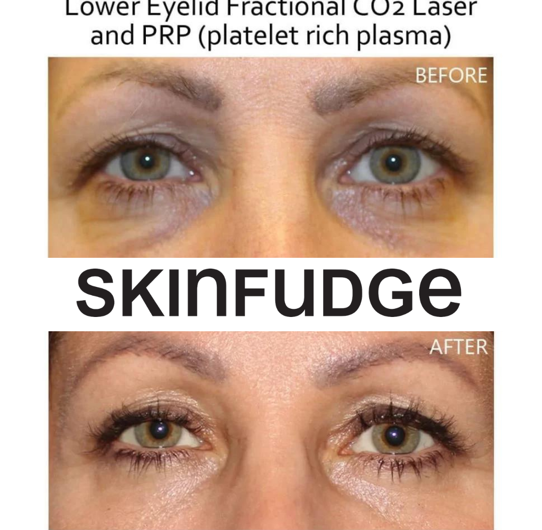 Under Eye PRP Treatment SKINFUDGE