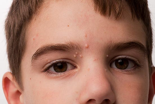 Molluscum Contagiosum in Children SKINFUDGE® Clinics (Dermatology, Plastic Surgery & Laser Center)