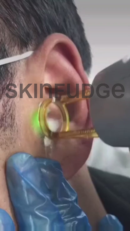 Male Ears Laser Hair Removal