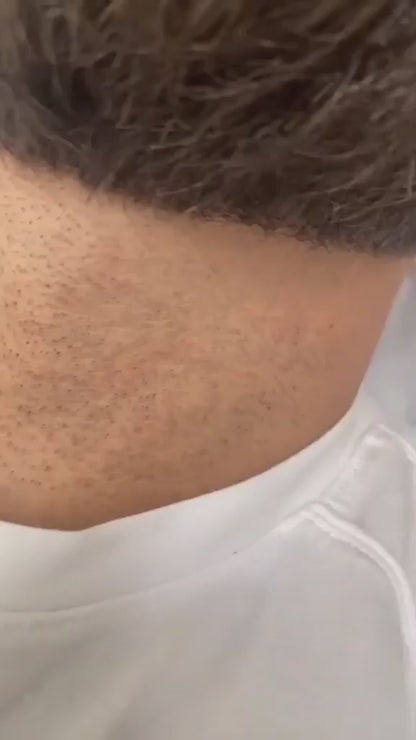 Beard Line Laser Hair Removal