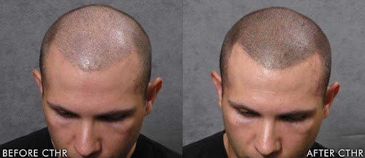 Scalp Micropigmentation (SMP) SKINFUDGE® - Center of Skin Excellence