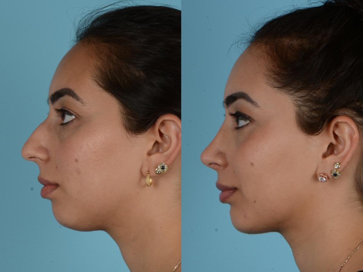 Cosmetic Rhinoplasty (Nose Reshaping Surgery) SKINFUDGE® Clinics (Dermatology, Plastic Surgery & Laser Center)