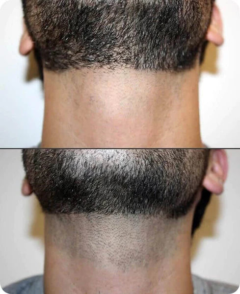 Beard Line Laser Hair Removal SKINFUDGE