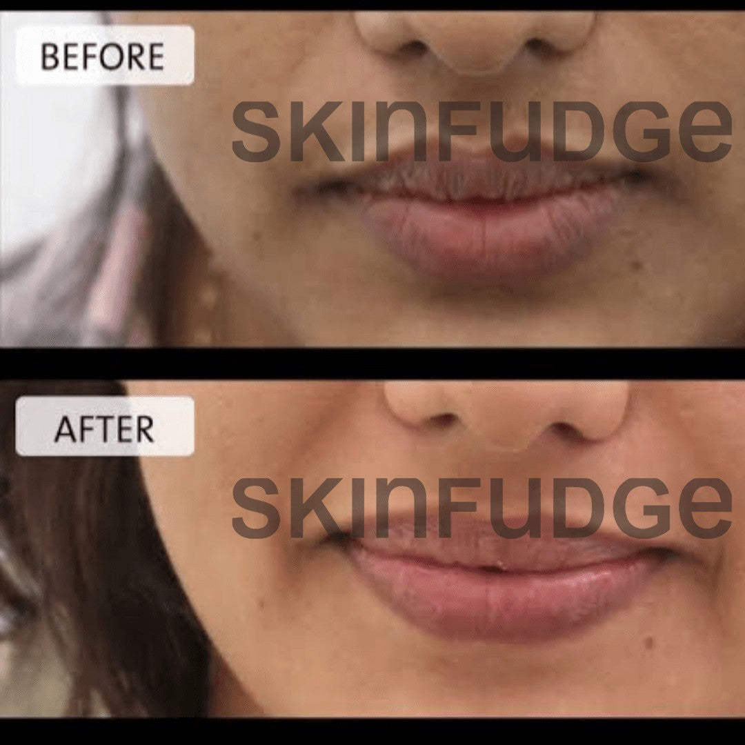 Lip Lightening Procedure SKINFUDGE® Clinics (Dermatology, Plastic Surgery & Laser Center)