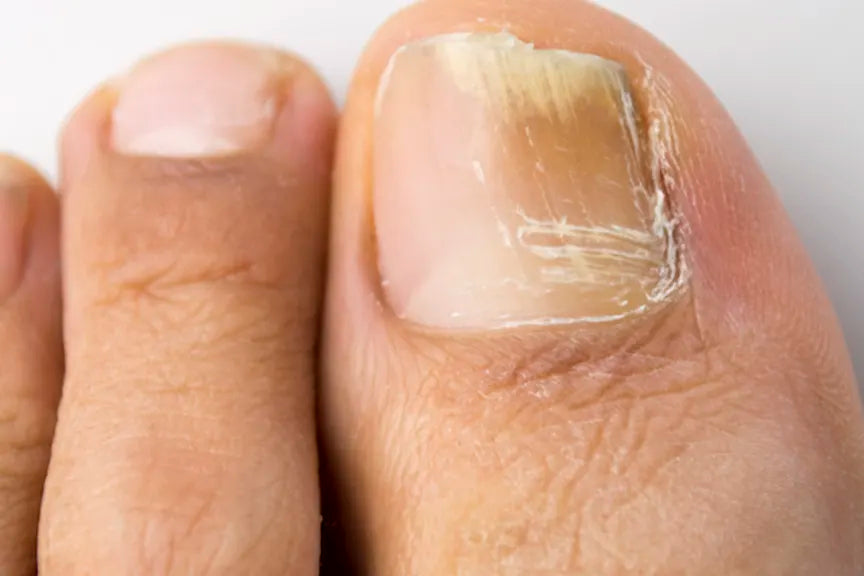Laser Toe Nail Fungus Removal Treatment SKINFUDGE® Clinics (Dermatology, Plastic Surgery & Laser Center)