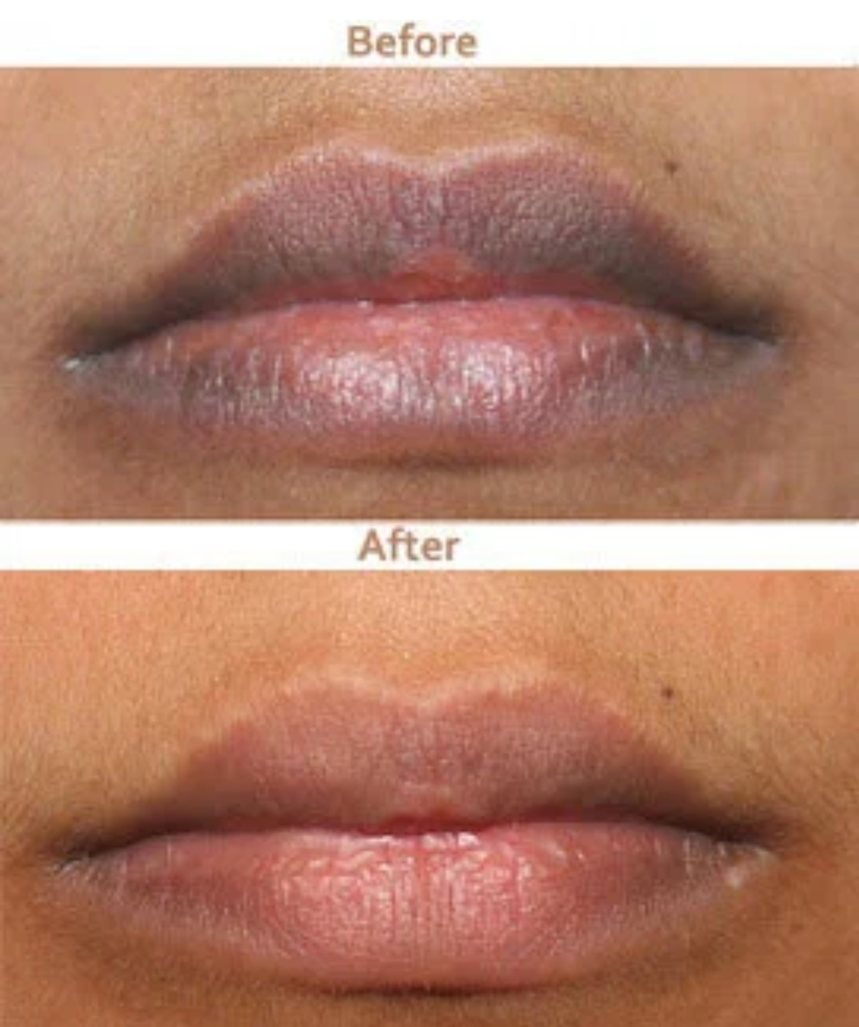 Smoker's Lip Lightening Treatment SKINFUDGE® Clinics (Dermatology, Plastic Surgery & Laser Center)