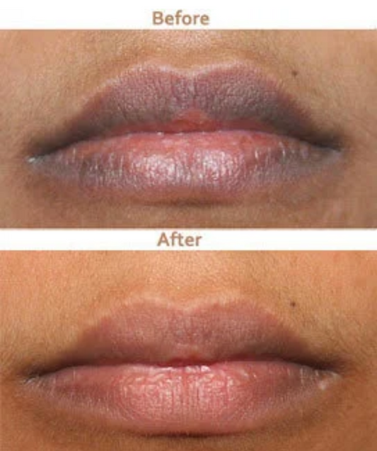 Smoker's Lip Lightening Treatment SKINFUDGE® Clinics (Dermatology, Plastic Surgery & Laser Center)