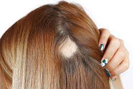 Alopecia Areata Treatment SKINFUDGE® Clinics (Dermatology, Plastic Surgery & Laser Center)