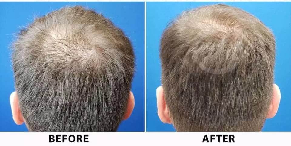 Hair Regrowth Treatment - (Dr. PRP Kit) SKINFUDGE