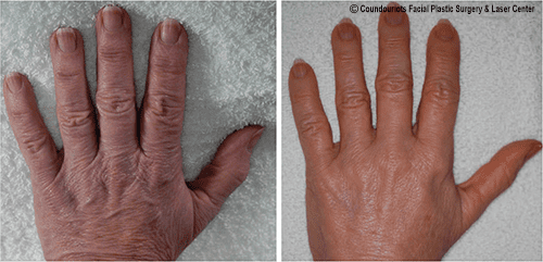Hand Rejuvenation / Younger Looking Hands SKINFUDGE
