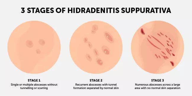 Hydra Rash Absess #1 Best Hidradenitis Suppurativa Treatment in Lahore | Rated ⭐⭐⭐⭐⭐ ...