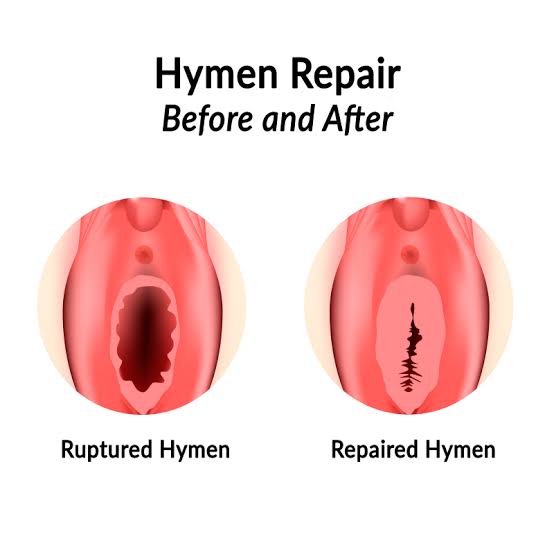 Hymen Repair (Hymen Reconstruction Surgery) SKINFUDGE® Clinics (Dermatology, Plastic Surgery & Laser Center)