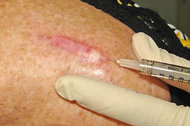 Intralesional Injections SKINFUDGE® Clinics (Dermatology, Plastic Surgery & Laser Center)