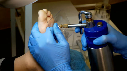 Liquid Nitrogen Cryotherapy Treatment for Warts SKINFUDGE