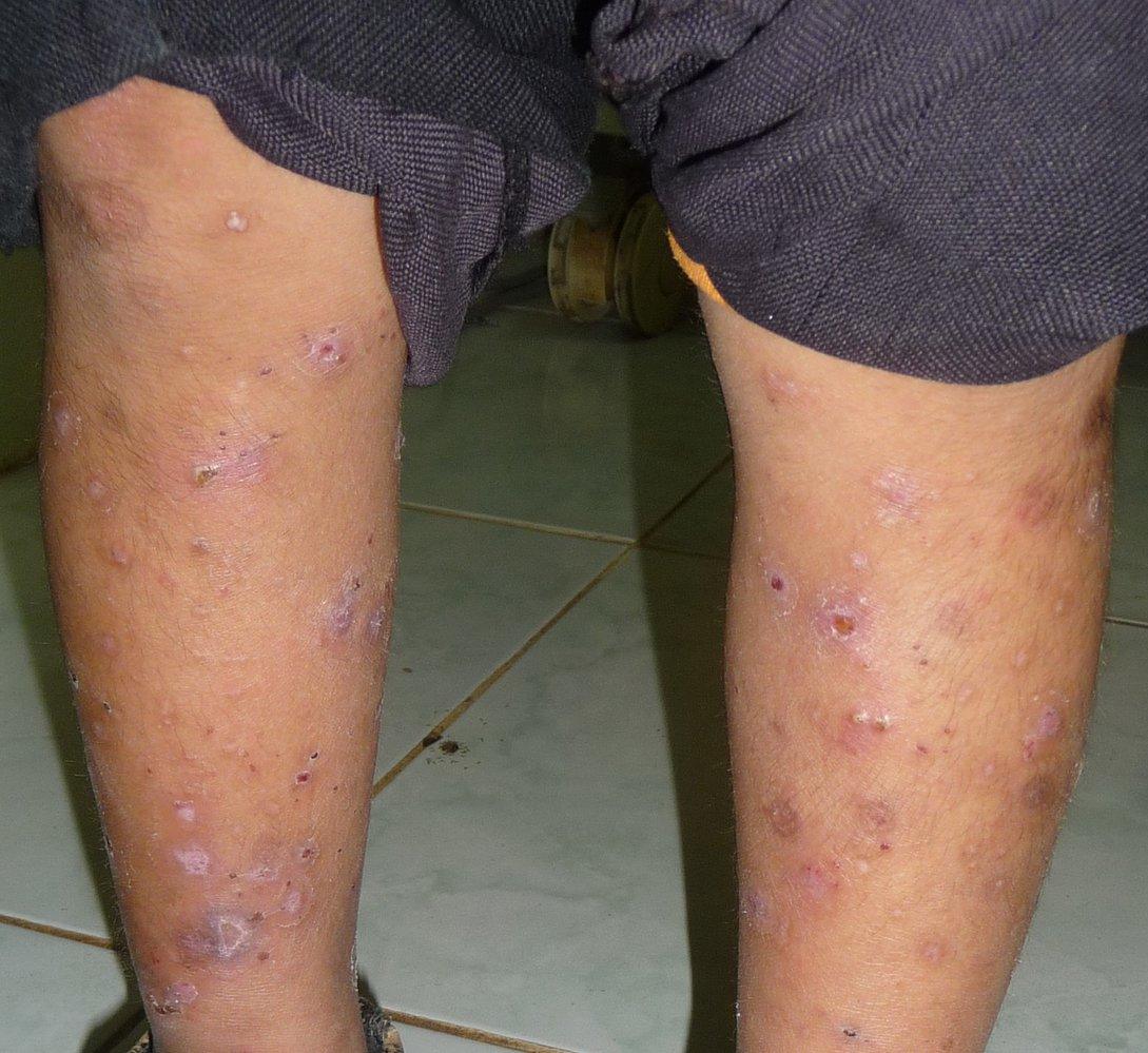 Scabies Treatment in Lahore – SKINFUDGE® - Center of Skin Excellence