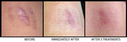 Self-Harm, Injury Marks Arm Scar Treatment with Fotona CO2 Laser SKINFUDGE