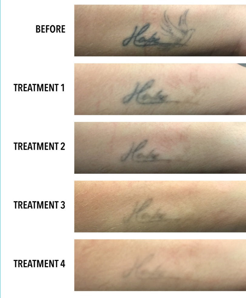 #1 Tattoo Laser Removal in Lahore SKINFUDGE