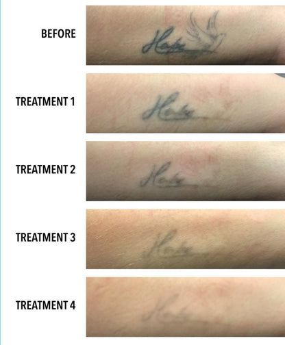#1 Tattoo Laser Removal in Lahore SKINFUDGE